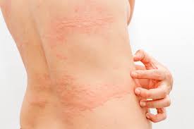 skin rashes facts types causes complications