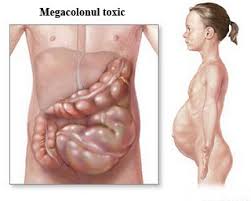 Ulcerul este o boala care apare ca urmare a lezarii mucoasei stomacului. Megacolonul Toxic Enciclopedie Oculusprim
