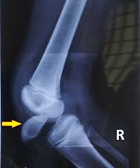 Narek melqonyan te ka lali shpirt. Traumatic Intra Articular Intercondylar Dislocation Of The Patella Reduced By The Closed Method With Open Quadriceps Repair In An Adolescent A Rare Case Report Abstract Europe Pmc