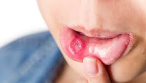 Canker sores are shallow ulcers. The Truth Behind Canker Sores Causes Of Canker Sores