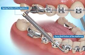 Draw the navel in toward the spine and press the lower back down into the floor. Forsus Springs A Patient S Guide Premier Orthodontics