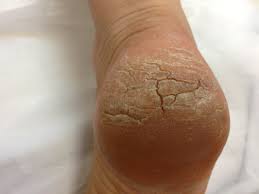 Heel Callus Cracked Heels Podantics Podiatry Adelaide