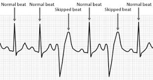 Your heart works in mysterious ways, and the truth is the irregular heartbeat/skipped beat is usually fairly instant. What Is An Irregular Heart Beat Cardiac College