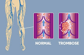 Trombose kan ontstaan in slagaderen en aderen. O Que E Uma Trombose Principais Sintomas E Tratamento Tua Saude