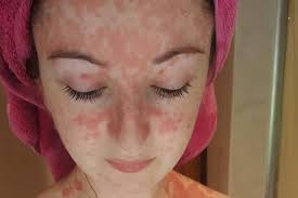 Mengenal jenis kulit wajahmu itu penting banget, terutama untuk mengetahui perawatan dan produk kecantikan yang perlu kamu pakai. 10 Kondisi Medis Yang Ditandai Muka Memerah Dan Iritasi