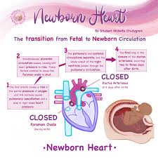 Image result for Delayed Transition from Fetal Circulation