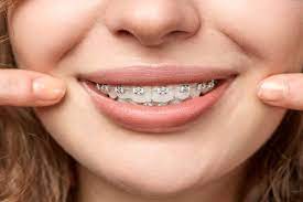 The smoother texture will prevent any pain too raw areas inside of your mouth. Is There A Problem With Removing Teeth For Braces Wexler Blog