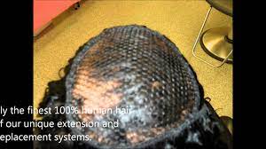 Inter Netting Help For Androgentic Alopecia Alopecia Alopecia Hairstyles Short Crochet Braids Hairstyles