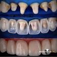 ZIRCONIA CROWN product image