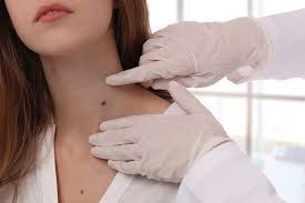 Some types of skin cancer are more dangerous than others, but if you have a spot. Just A Mole Or Is It Skin Cancer The Iowa Clinic