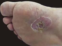 Major signs that indicate bone cancer in foot and ankle. Solitary Plantar Basal Cell Carcinoma Sciencedirect