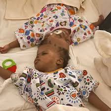 Twin sisters Mercy and Goodness, born joined at the skull in Nigeria in  June 2023, have been successfully separated after a series of  groundbreaking AI-assisted surgeries. The rare craniopagus twins underwent  four