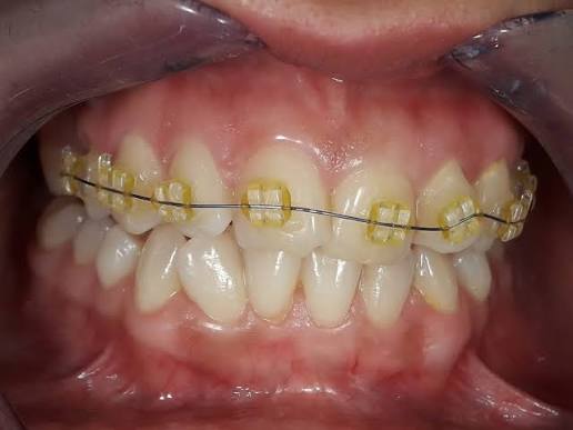 Disadvantages of ceramic braces and alternatives