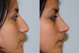 Nose job (rhinoplasty) rhinoplasty, or nose surgery, is one of the most popular cosmetic procedures offered at our northern california locations from napa and san francisco to union city. Nose Job Pasadena Revision Rhinoplasty Los Angeles Dr Panossian