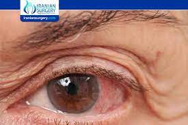 Glaucoma is a progressive vision condition that can lead to permanent blindness. Glaucoma Symptoms And Causes Symptoms Of Open Angle Glaucoma