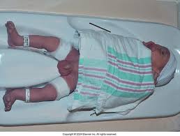 Image result for Neonatal Circumcision