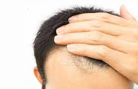 Early Signs Of Balding 10 Signs You Re Starting To Lose Your Hair Ds Healthcare Group