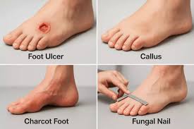 Image result for diabetic toes