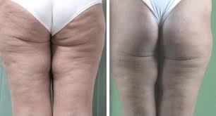 Getting rid of cellulite is no mean feat. Cellulite And Focused Extracorporeal Shockwave Therapy For Non Invasive Body Contouring A Randomized Trial Springerlink