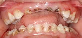 Pictures of rotten teeth from not brushing. Preventing The Most Common Chronic Disease Of Childhood