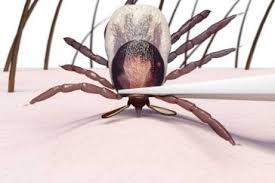 Image result for Tick Removal