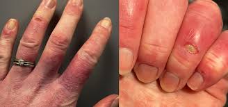 Image result for Chilblains