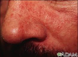 Image result for Beard Dermatitis