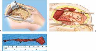Microsurgery information for surgeons, health care professionals and patients, with detailed procedure descritpions. A Flap Harvest Proceeds From Distal To Proximal Once The Vessels Download Scientific Diagram