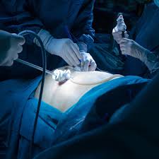 What are the requirements to become a surgeon? Hiatal Hernia Surgery What To Expect On The Day Of Surgery