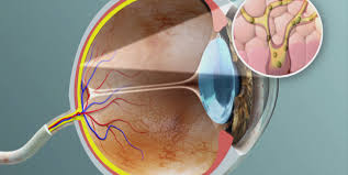 La maladie peut prendre plusieurs formes. Cancer De L Oeil Quels Traitements