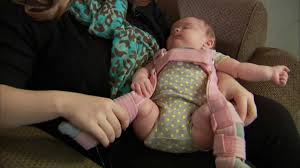 Imaging or routine radiographs of the. Baby Hip Instability And Dysplasia Mayo Clinic Youtube