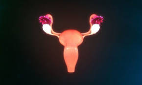 Beginning menstruation at an early age or starting menopause at a later age, or both, may increase the risk of ovarian cancer. Ovarian Cancer Tumor Tissue Samples Bay Biosciences