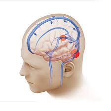 Pulsatile Tinnitus Weill Cornell Brain And Spine Center