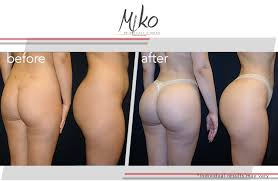 Bad bbl fixed by dr. Brazilian Butt Lift Beverly Hills Plastic Surgeon Miko Plastic Surgery