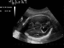 Choroid Plexus Cyst Wikipedia