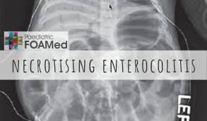 Image result for Necrotizing Enterocolitis