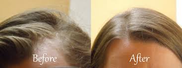 However, another common cause of flakes in the hair is excess shampoo or conditioner that is not completely washed out. Dandruff Remedies Homemade Dandruff Treatment016 Dandruff Remedy Dandruff Treatment Shampoos Dandruff Treatment