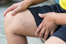These patches may be oval or circular. Relief For Swollen Legs Diabetic Foot And Wound Center Wound Care Specialists