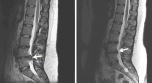 Mehr über die symptome, ursachen, therapie und vorbeugung von einm bandscheibenvorfall. Wie Sich Ein Bandscheibenvorfall Ohne Operation Zuruckbildet Springerlink
