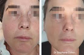 Traitement des taches brunes au laser à Créteil dans le Val de Marne (94)