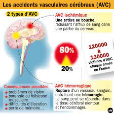 Par exemple, lors de la souscription à un abonnement (internet, téléphonie mobile…), on vous demandera de transmettre votre code iban afin que la société puisse mettre en place le prélèvement automatique. L Avc Premiere Cause De Handicap Chez Les Adultes