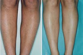 Remove unwanted leg hair quickly and easily with the finishing touch flawless legs women's hair remover. Laser Hair Removal Treatments Breckenridge Co Blue Sage Spa