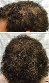 Are you experiencing hair loss for a while and do not know why? Nonscarring Alopecia Associated With Vitamin D Deficiency Mdedge Dermatology