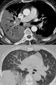 La bactérie se développe dans les réseaux d'eau douce naturels ou artificiels et dans un milieu organique favorable à. Https Www Thieme Connect Com Products Ejournals Pdf 10 1055 S 0029 1241982 Pdf