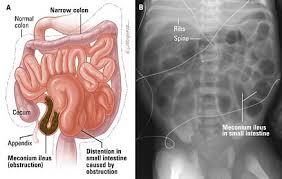Image result for Adynamic Ileus