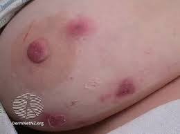 Image result for heat rash under breasts