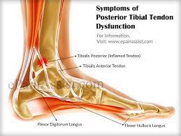 Symptoms Of Tibialis Posterior Syndrome Or Posterior Tibial Tendon Dysfunction Tendonitis Symptoms Ankle Tendonitis Posterior Tibial Tendonitis
