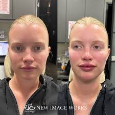 Chicago LIPS•FILLER•BOTOX•PRF