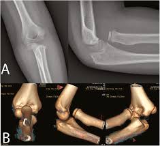 Image result for Radial Head Dislocation