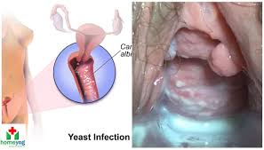 Image result for vaginal yeast infection